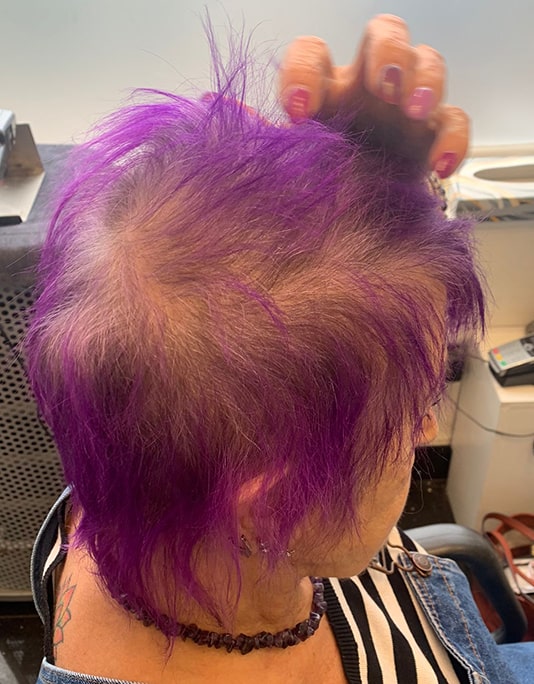 Hair InXs Womens Hair Loss Transformation Gallery Before