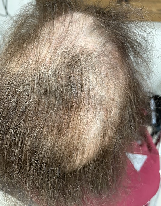 Hair InXs Womens Hair Loss Transformation Gallery Before