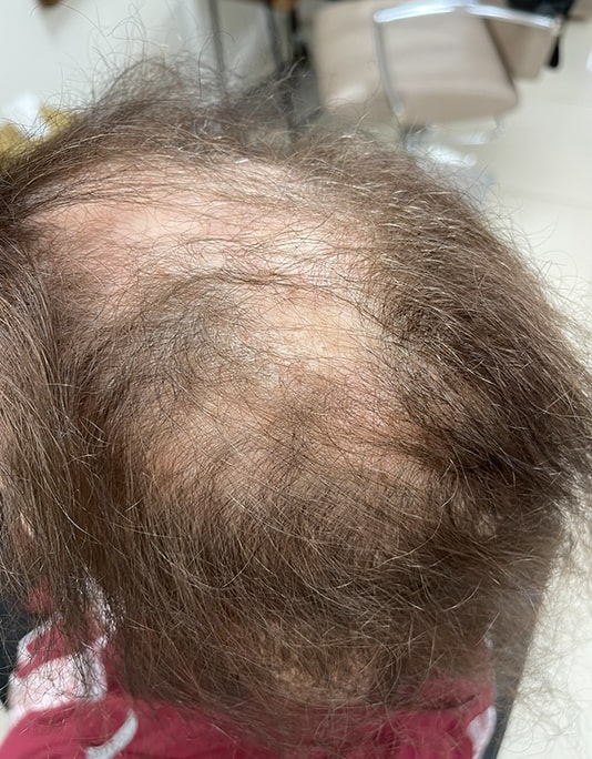 Hair InXs Womens Hair Loss Transformation Gallery Before
