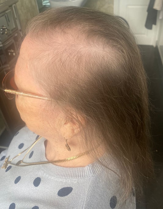 Hair InXs Womens Hair Loss Transformation Gallery Before