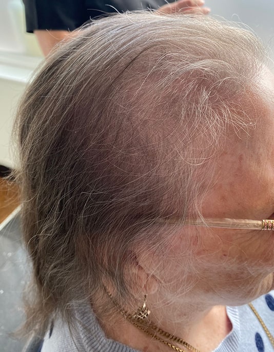 Hair InXs Womens Hair Loss Transformation Gallery Before