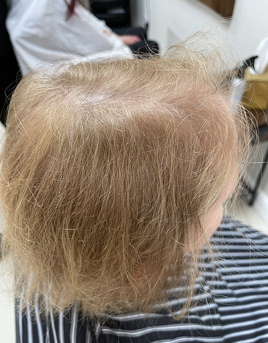 Hair InXs Womens Hair Loss Transformation Gallery Before