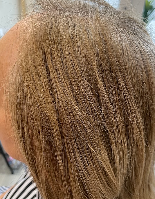 Hair InXs Womens Hair Loss Transformation Gallery Before