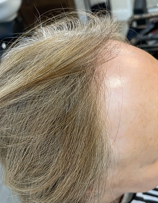 Hair InXs Womens Hair Loss Transformation Gallery Before