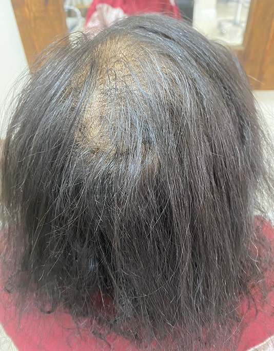 Hair InXs Womens Hair Loss Transformation Gallery Before