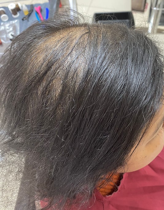 Hair InXs Womens Hair Loss Transformation Gallery Before