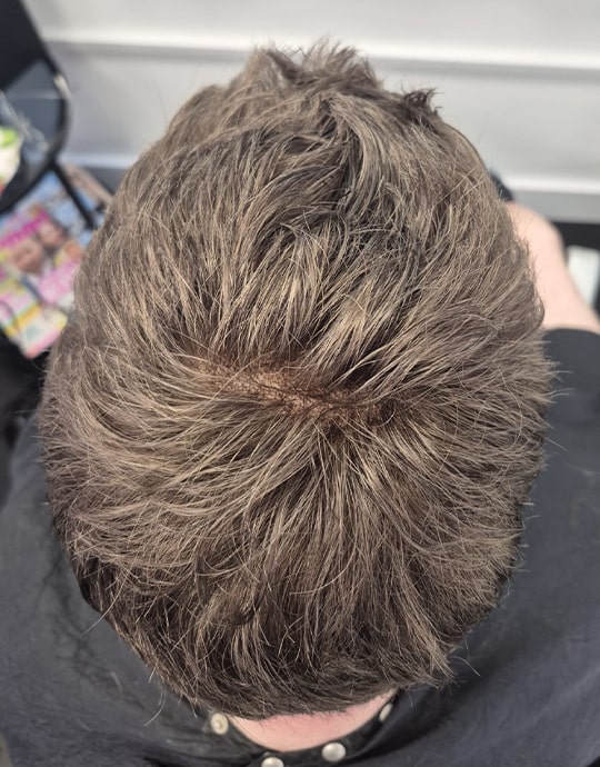 Hair InXs Mens Hair Loss Transformation Gallery After