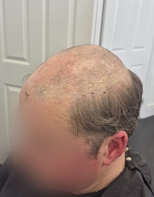 Hair InXs Mens Hair Loss Transformation Gallery Before