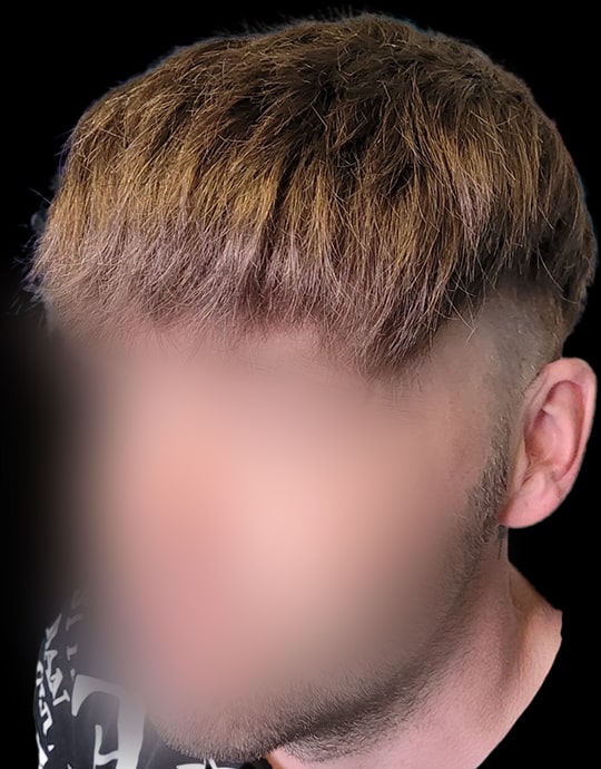 Hair InXs Mens Hair Loss Transformation Gallery After