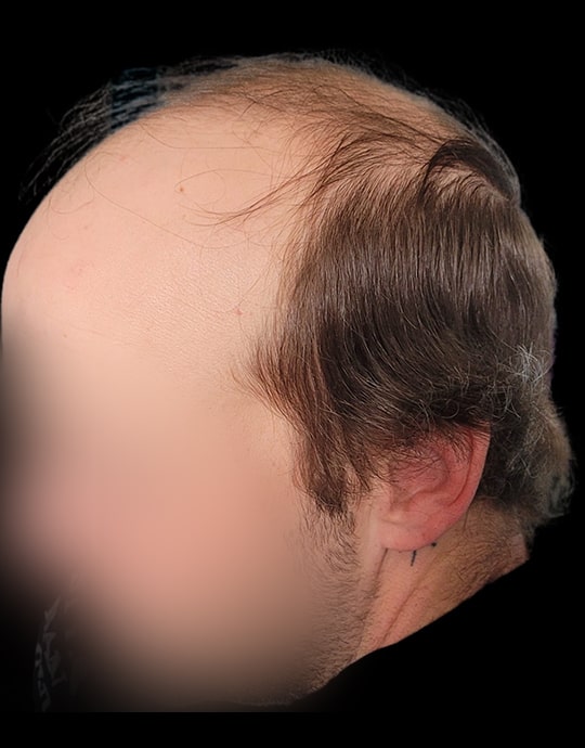 Hair InXs Mens Hair Loss Transformation Gallery Before