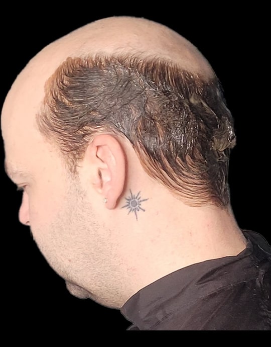 Hair InXs Mens Hair Loss Transformation Gallery Before