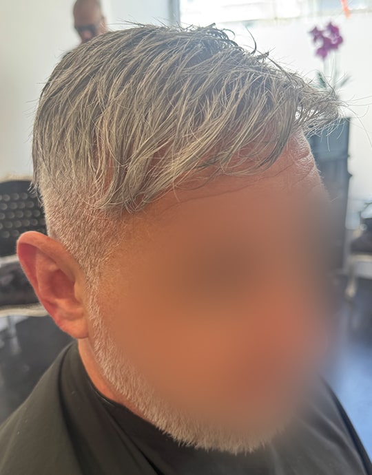 Hair InXs Mens Hair Loss Transformation Gallery After