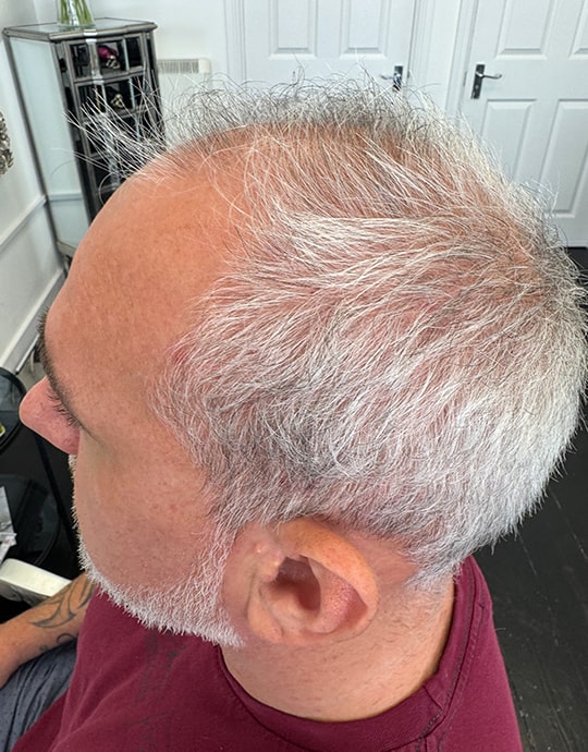 Hair InXs Mens Hair Loss Transformation Gallery Before
