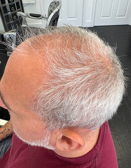Hair InXs Mens Hair Loss Transformation Gallery Before