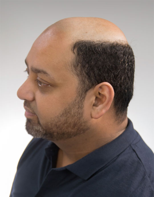 Hair InXs Mens Hair Loss Transformation Before