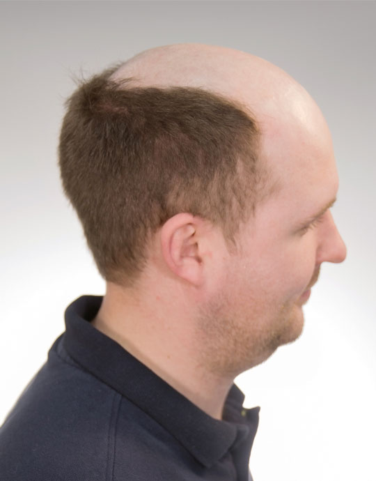 Hair InXs Mens Hair Loss Transformation Before