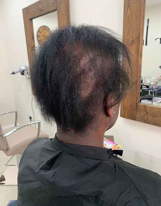 Hair InXs Womens Hair Loss Transformation Gallery Before