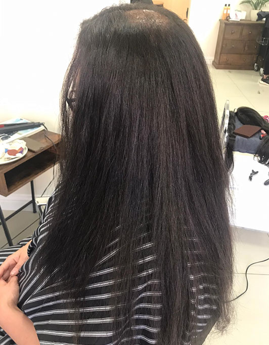 Hair InXs Womens Hair Loss Transformation Gallery Before