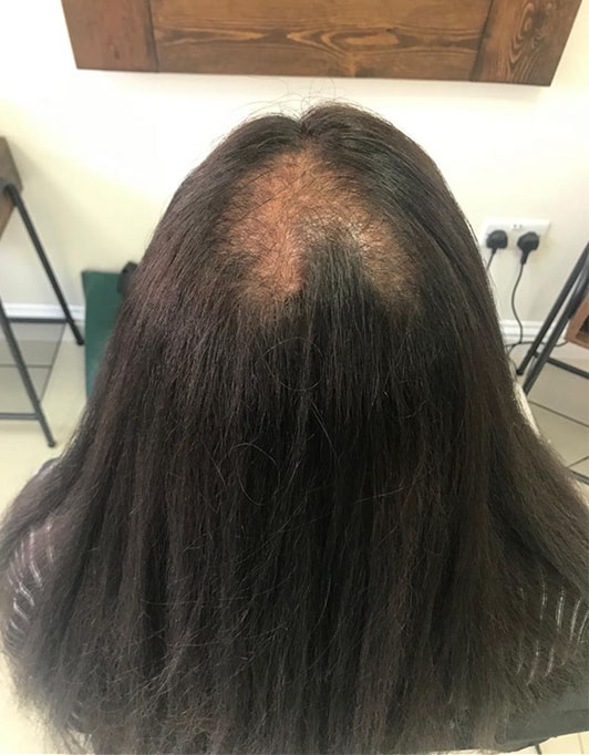 Hair InXs Womens Hair Loss Transformation Gallery Before