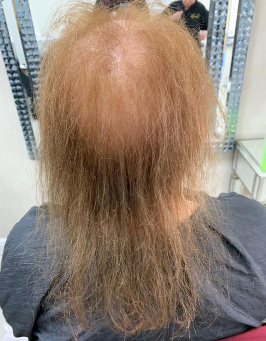Hair InXs Womens Hair Loss Transformation Gallery Before