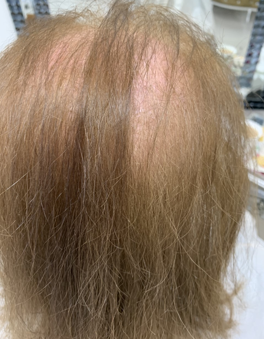 Hair InXs Womens Hair Loss Transformation Gallery Before