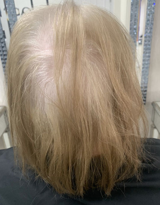 Hair InXs Womens Hair Loss Transformation Gallery Before
