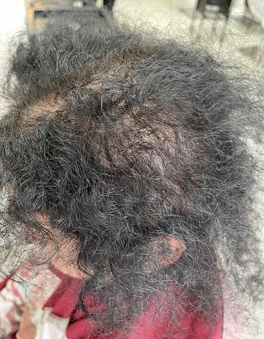 Hair InXs Womens Hair Loss Transformation Gallery Before