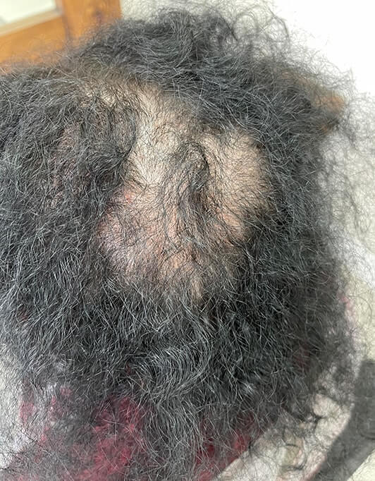 Hair InXs Womens Hair Loss Transformation Gallery Before