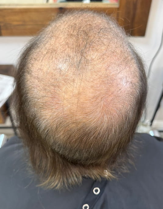 Hair InXs Womens Hair Loss Transformation Gallery Before
