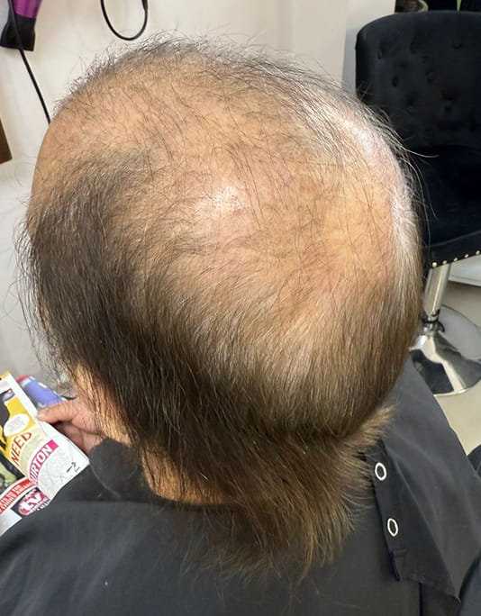 Hair InXs Womens Hair Loss Transformation Gallery Before