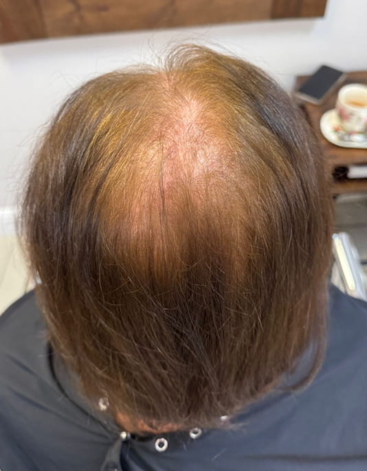 Hair InXs Womens Hair Loss Transformation Gallery Before