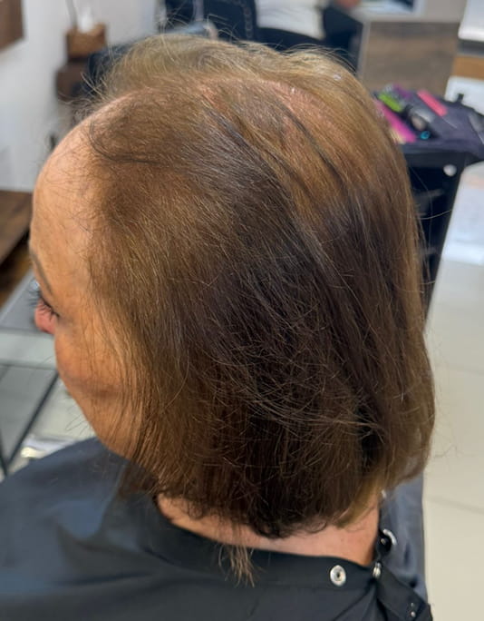 Hair InXs Womens Hair Loss Transformation Gallery Before