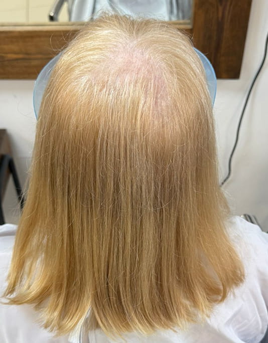 Hair InXs Womens Hair Loss Transformation Gallery Before