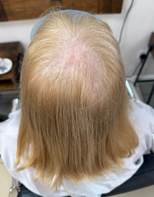 Hair InXs Womens Hair Loss Transformation Gallery Before