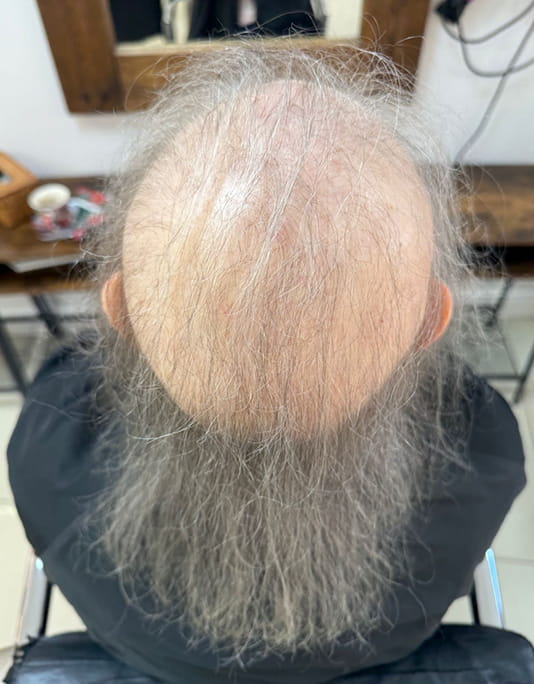 Hair InXs Womens Hair Loss Transformation Gallery Before