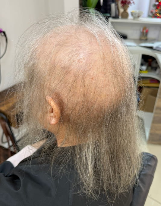 Hair InXs Womens Hair Loss Transformation Gallery Before