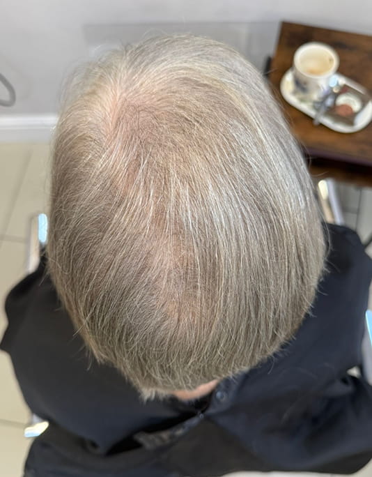 Hair InXs Womens Hair Loss Transformation Gallery Before