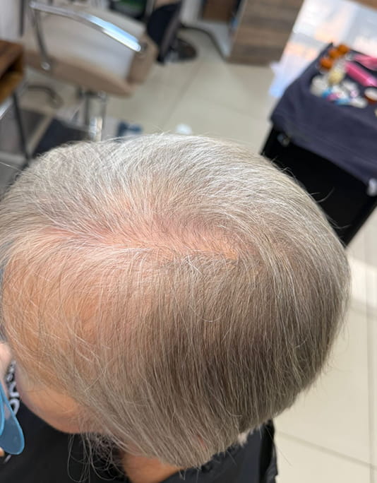 Hair InXs Womens Hair Loss Transformation Gallery Before