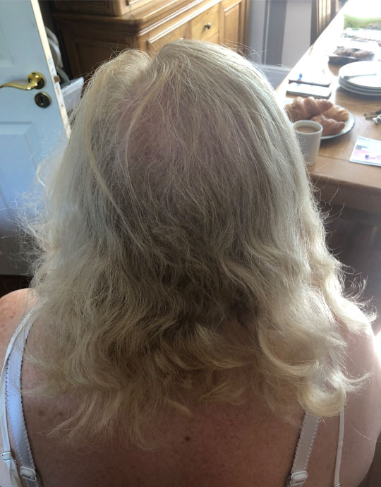 Hair InXs Womens Hair Loss Transformation Before
