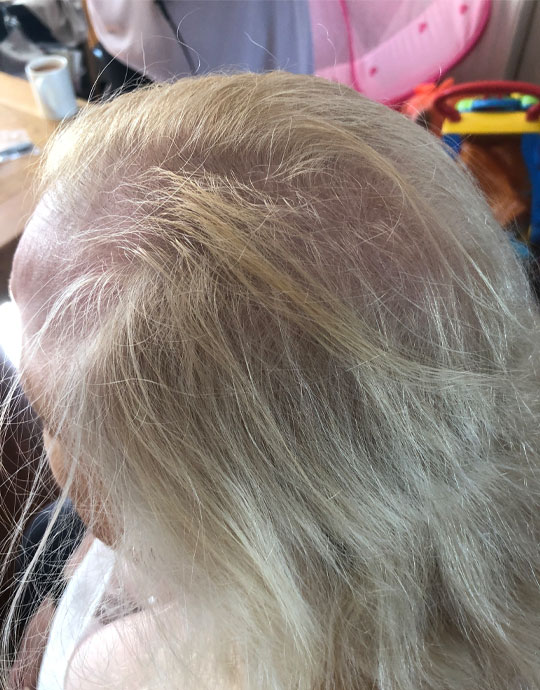 Hair InXs Womens Hair Loss Transformation Before