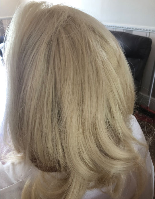 Hair InXs Womens Hair Loss Transformation After