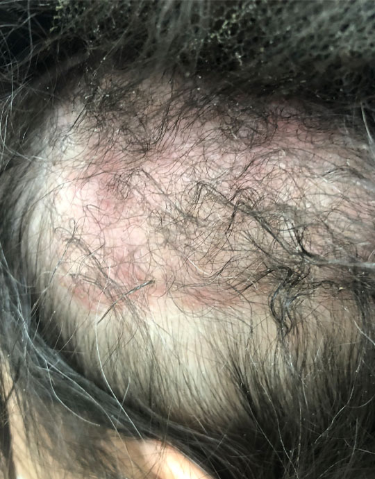 Hair InXs Womens Hair Loss Gallery Before