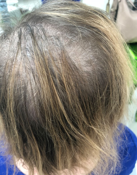 Hair InXs Womens Hair Loss Gallery Before