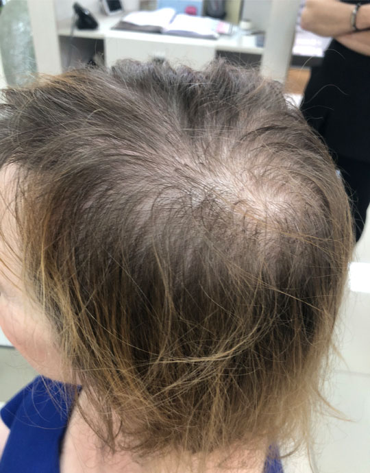 Hair InXs Womens Hair Loss Gallery Before