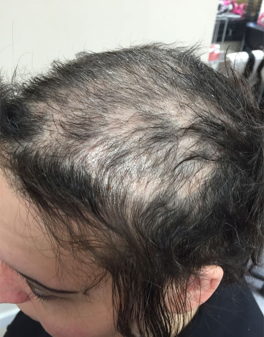 Hair InXs Womens Hair Loss Transformation Before