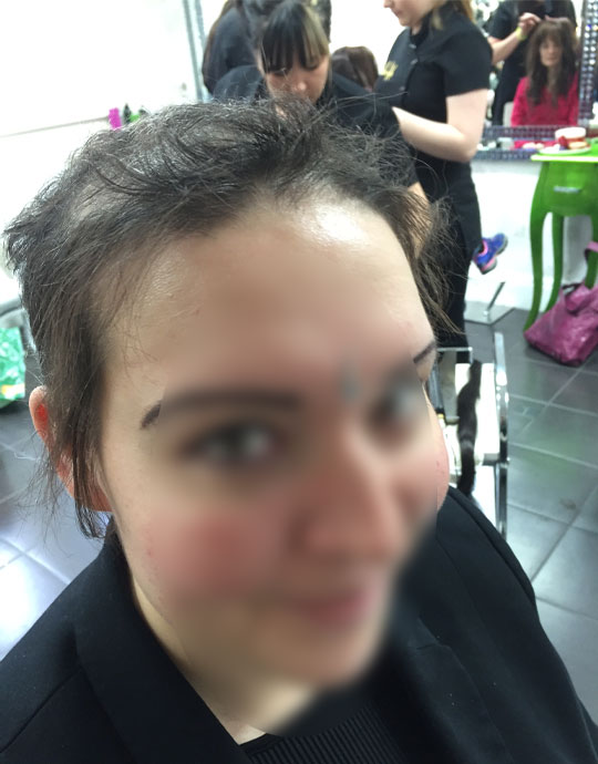 Hair InXs Womens Hair Loss Transformation Before