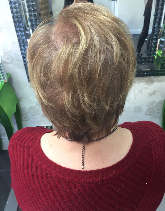 Hair InXs Womens Hair Loss Transformation Before