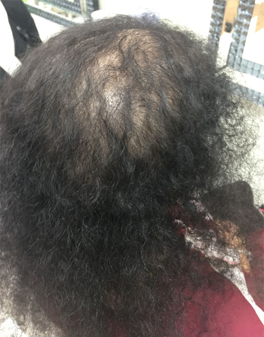 Hair InXs Womens Hair Loss Transformation Gallery Before
