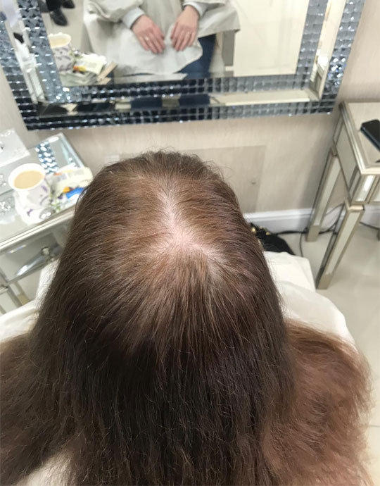 Hair InXs Womens Hair Loss Transformation Gallery Before