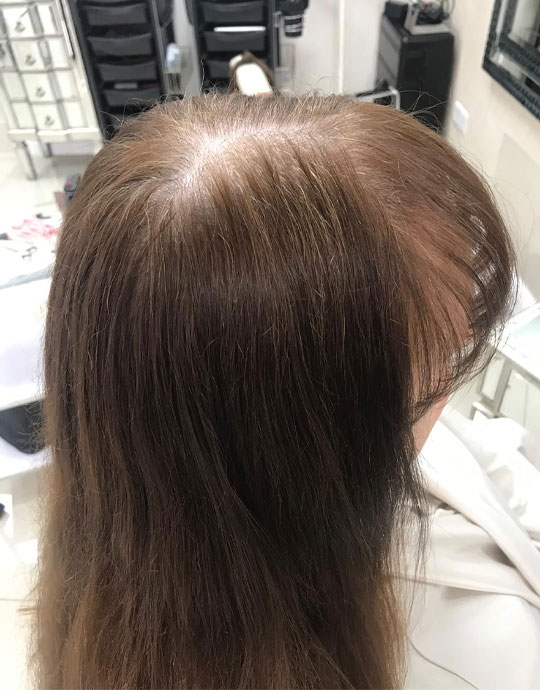 Hair InXs Womens Hair Loss Transformation Gallery Before